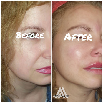 Контурная пластика скул
                    Косметолог Алена Харьков