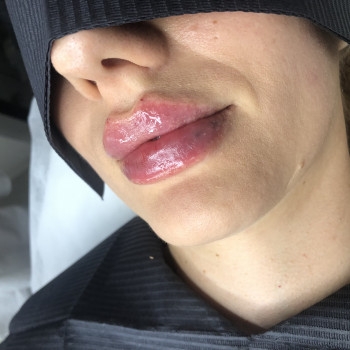 Контурная пластика губ,  Juvederm Ultra 3
                    Врач-косметолог Екатерина Киев