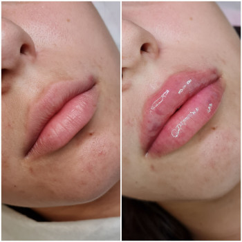 Збільшення губ
                    Косметолог-инъекционист Віталія Ивано-Франковск