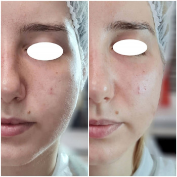 Radiesse
                    Косметолог-инъекционист Віталія Ивано-Франковск