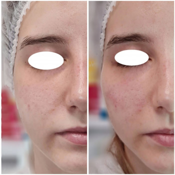 Radiesse
                    Косметолог-инъекционист Віталія Ивано-Франковск