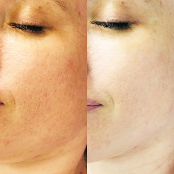 Макро після алмазного пілінгу