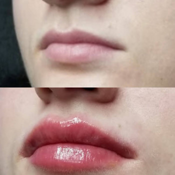 Увеличение губ