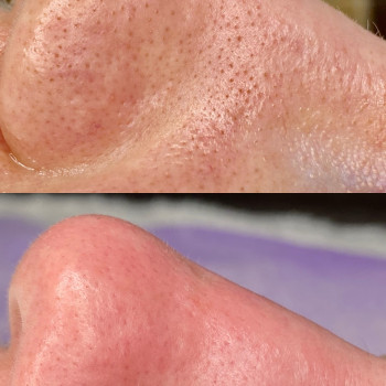 Чистка лица