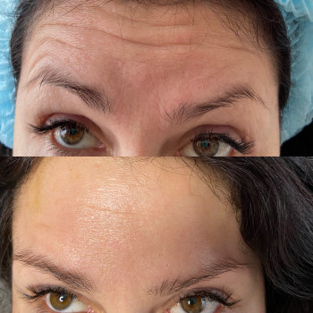 Инъекции ботокса