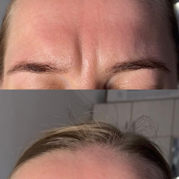 До и после ботокса