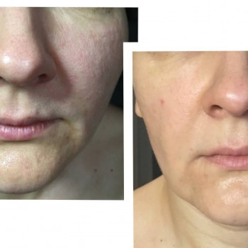 Массаж лица
                    Косметолог-эстетист Надежда Киев