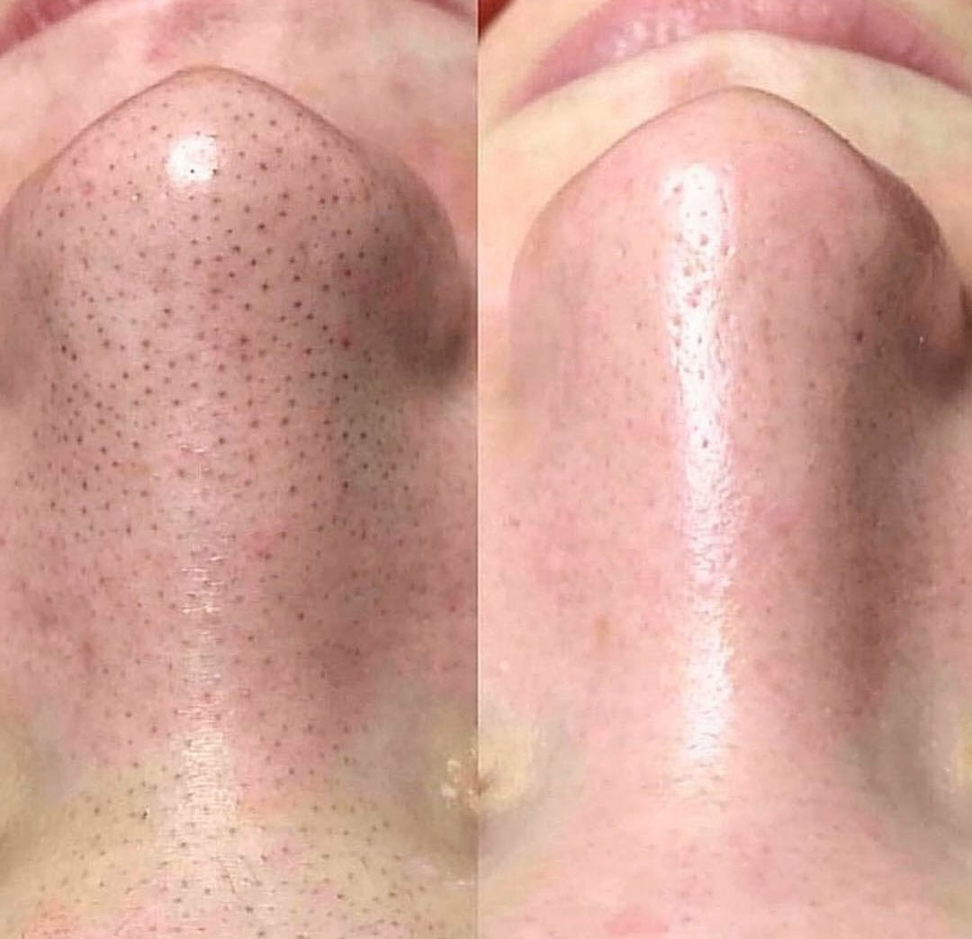 чистка лица. чистка лица. черные точки косметолог. черные точки косметолог. чистка лица ультразвуком до и после.