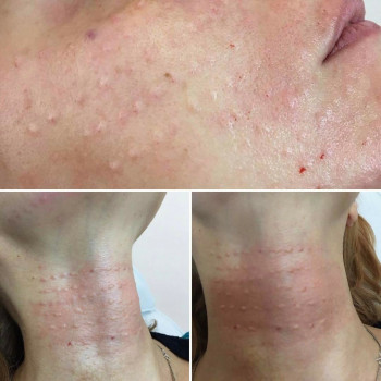 Біорепарація обличчя шиї декольте
                    Лікар-косметолог Юлия Харків