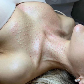 Біорепарація обличчя шиї декольте
                    Лікар-косметолог Юлия Харків