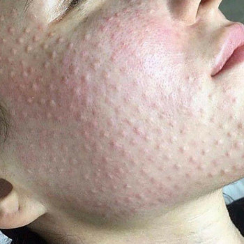 Біорепарація обличчя шиї декольте
                    Лікар-косметолог Юлия Харків