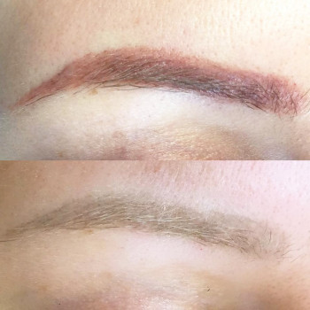 Удаление татуажа лазером
                    Майстер перманентного макіяжу Ксения Кобылянская Київ