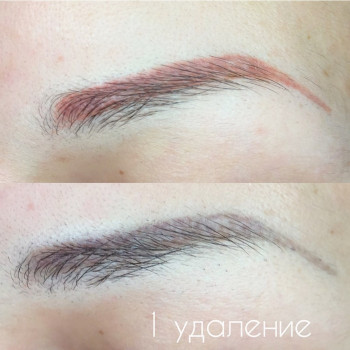 Удаление татуажа лазером
                    Майстер перманентного макіяжу Ксения Кобылянская Київ