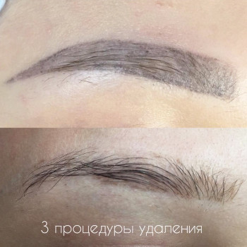 Удаление татуажа лазером
                    Майстер перманентного макіяжу Ксения Кобылянская Київ