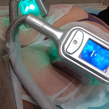 кріоліполіз зона сідниці