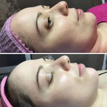 Результат першої половини курсу кислотних пілінгів