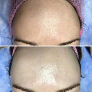 Результат першої половини курсу кислотних пілінгів