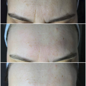 Результата процедури ''4D ліфтинг''