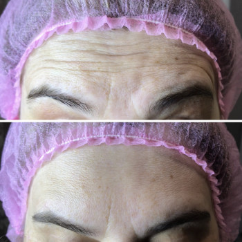 Результат двох тижнів після введення Ботулінотоксину (Ботокс