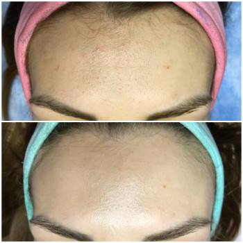 Результат повного курсу кислотних пілінгів