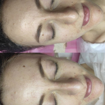 Химический пилинг
                    Врач-косметолог Татьяна Одесса