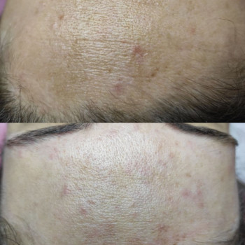 Химический пилинг
                    Врач-косметолог Татьяна Одесса