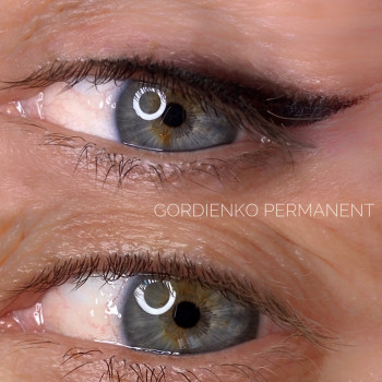 Зажившая стрелка века после 1 процедуры