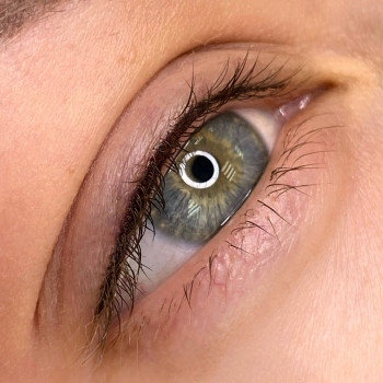 Зажившая стрелка века после 2 процедур