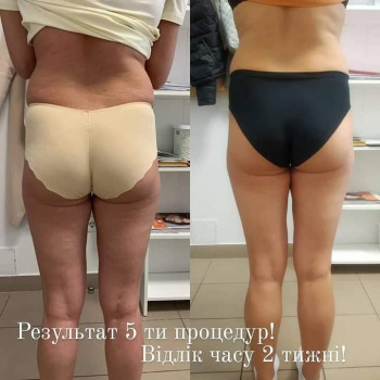 Вакуумно роликовий антицелюлітний масаж
                    Масажист Оксана Львів