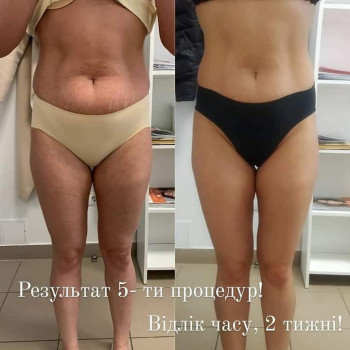 Вакуумно роликовий антицелюлітний масаж
                    Масажист Оксана Львів