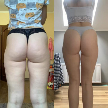 Вакуумно роликовий антицелюлітний масаж
                    Масажист Оксана Львів