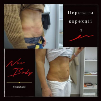 Вакуумно роликовий антицелюлітний масаж
                    Масажист Оксана Львів