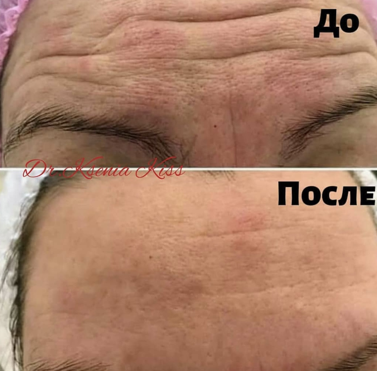 Биоревитализация тела Новое строение - Киев: 6 мастеров - Отзывы, Цены