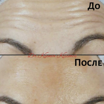 Ботулинотерапия верхней трети лица( лоб и межбровье)