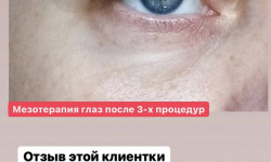 Мезотерапия для глаз Косметолог Наталия Полтава