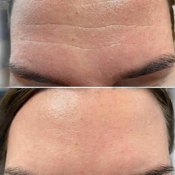 Коррекция морщин филлером (носогубки, лоб)
                    Врач-косметолог Юлия Харьков