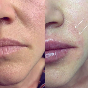 Коррекция морщин филлером (носогубки, лоб)
                    Врач-косметолог Юлия Харьков