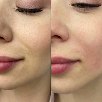 Коррекция морщин филлером (носогубки, лоб)
                    Врач-косметолог Юлия Харьков