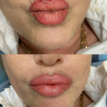 Коррекция морщин филлером (носогубки, лоб)
                    Врач-косметолог Юлия Харьков