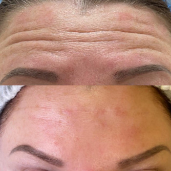 Коррекция морщин филлером (носогубки, лоб)
                    Врач-косметолог Юлия Харьков