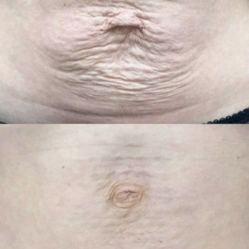 Коррекция фигуры
                    Косметолог Наталия Полтава