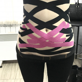 Дренажное тейпирование.