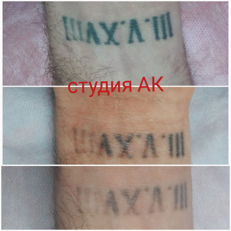 Удаление тату
                    Косметолог Ольга Мелитополь