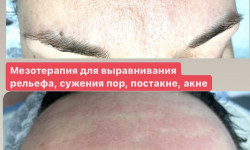 Микронидлинг - аппаратная мезотерапия Косметолог Наталия Полтава