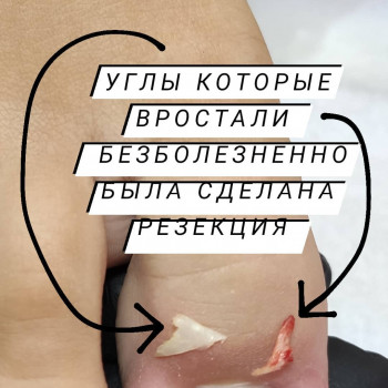 Вросший ноготь