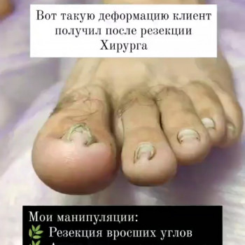 Деформация ногтевой пластины