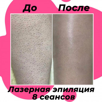 Комплекс лазерної епіляції №3 (глибоке бікіні + пахви+ гомілки + коліна + стегна частково + пальці на ногах по бажанню)
                    Салон красоты Мастерская Красоты "Юлии Юдиной" Киев