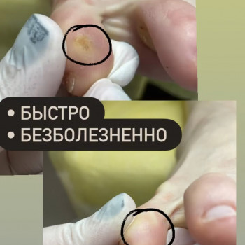 Удаление мозолей
