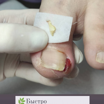 Вросший ноготь