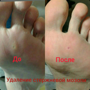 Удаление стержневой мозоли